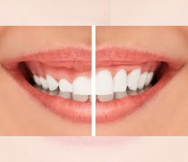 Gingivectomy & Gingivoplasty