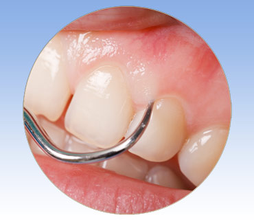 Periodontal Surgery